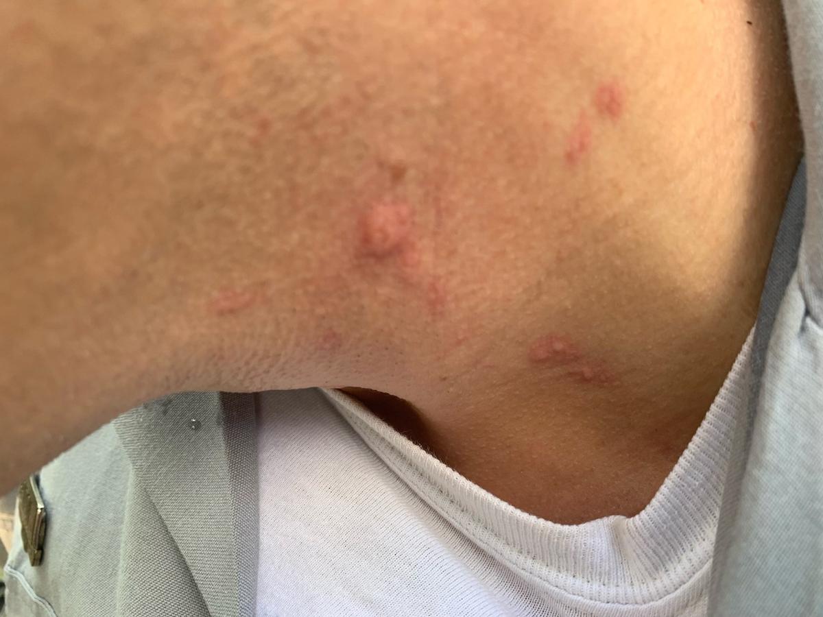 Master Trooper W.B. Benton shows wounds that he says were caused when Tristan Vereen gained control of his taser and pressed it to the trooper’s neck. So thereafter, Trooper Benton shot Vereen in the chest..