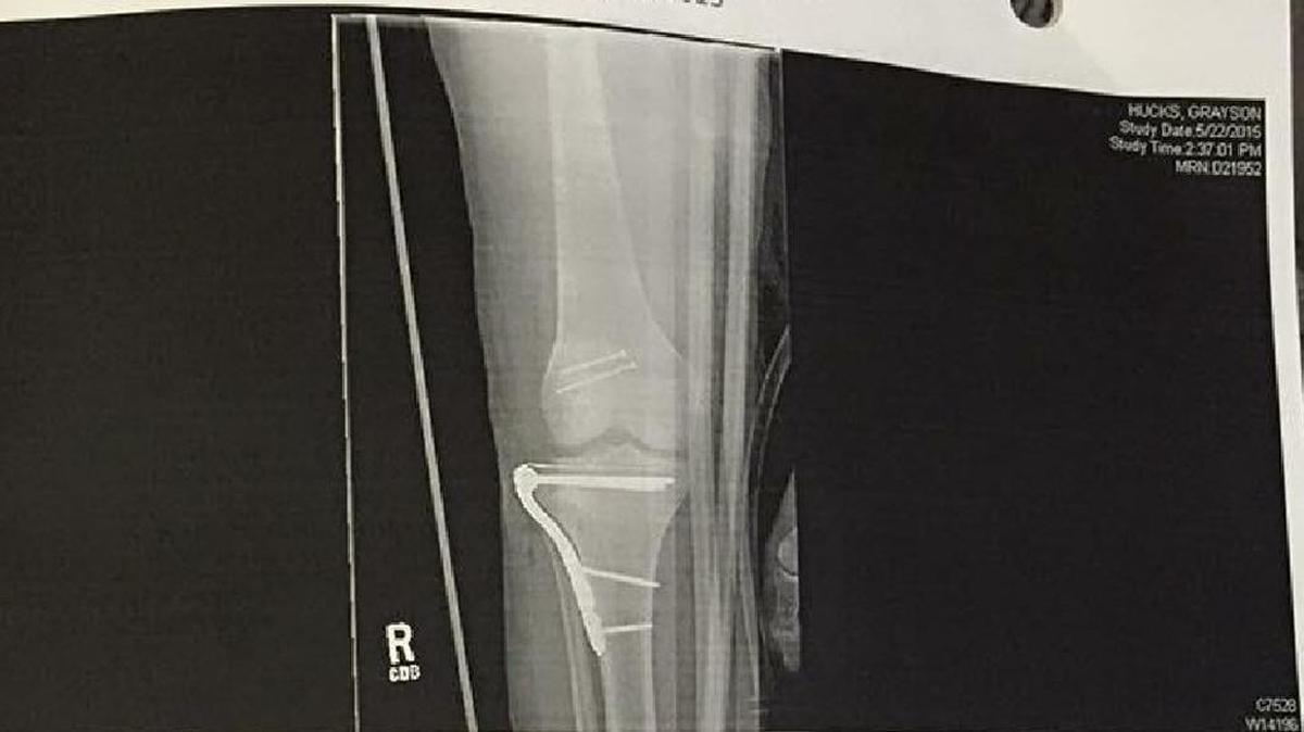 X-ray of Grayson Hucks' leg after 2015 car accident